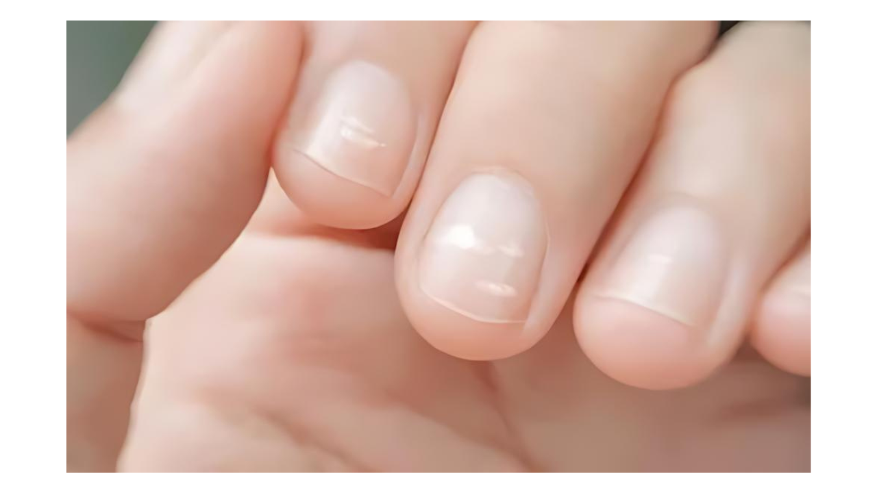 Nail health