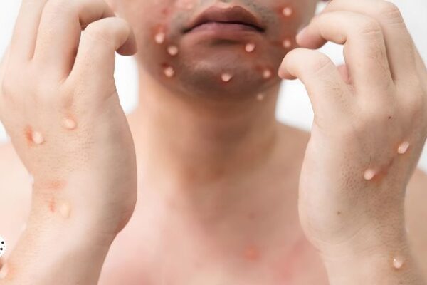 Monkeypox symptoms