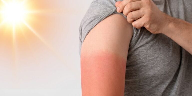 Tips to Prevent sunburn in summer
