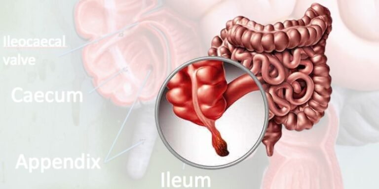 Millennials Face Rising Appendix Cancer Risk